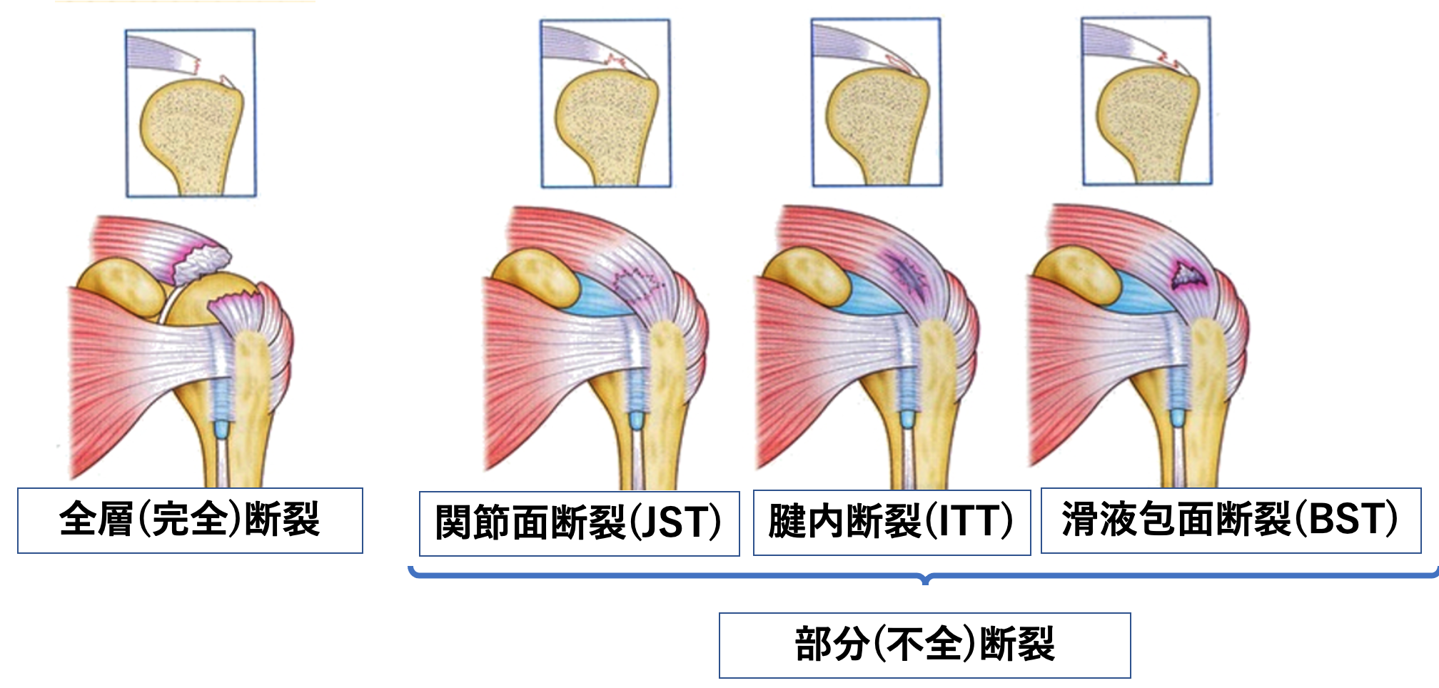 肩腱板断裂は「即手術」じゃない?整体師が教える保存療法の重要性!!須坂トータルケア整体院