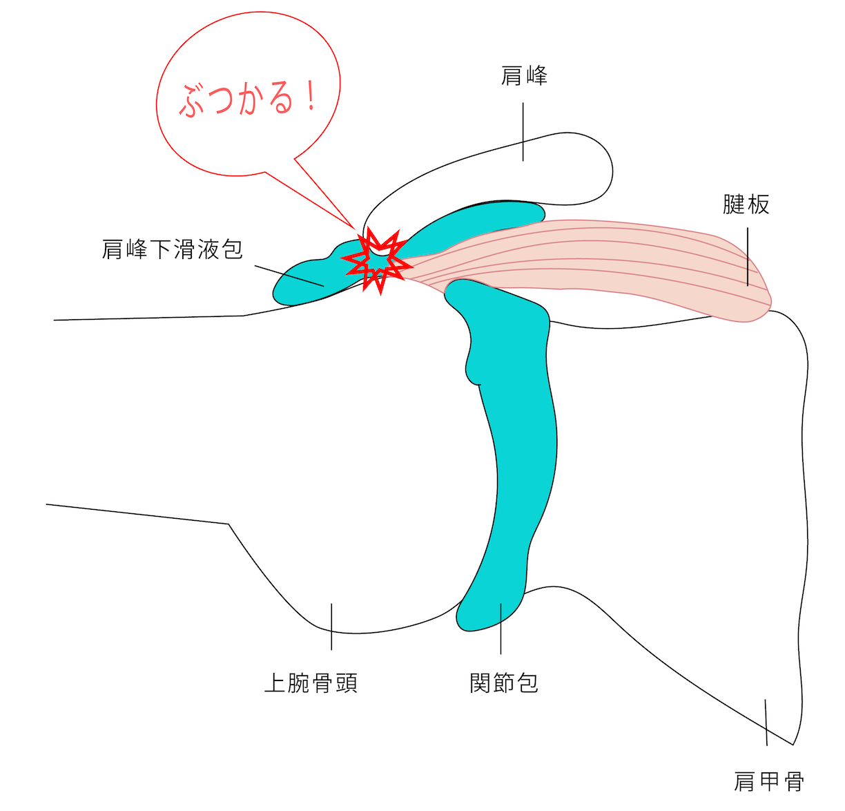 肩峰下インピンジメント症候群の説明画像